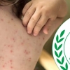 Health Measles-like symptoms leave three dead, suspected cases rise by 1,218