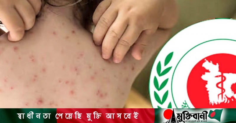 Health Measles-like symptoms leave three dead, suspected cases rise by 1,218